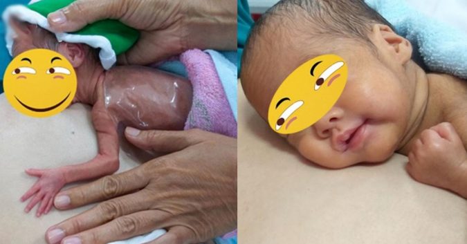 Long An : Bé sinh non 700 gam hồi sinh kì diệu nhờ da kề da với mẹ sau sinh