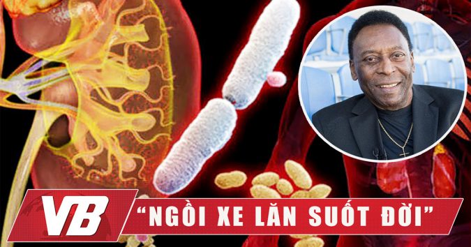 Vua Bóng Đá – Pele và căn bệɴh khiến ông “Ngồi Xe Lăn và Khổ Tới Cuối Đời”