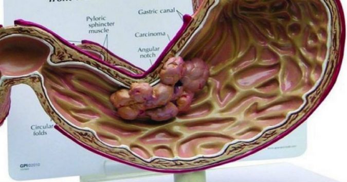 Nếu bạn cố gắng làm 11 việc này thì UNG THƯ sẽ “không còn đất sống”