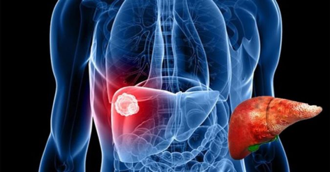 Thấy những dấu hiệu này cần đi khám ngay lập tức để cứu lấy lá gan của bạn