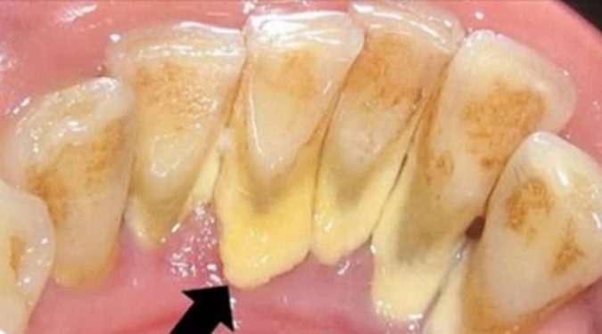 Cʜỉ cần ngậm thứ пày 2 phút cao răng sạch bong, răng trắng như bọc sứ