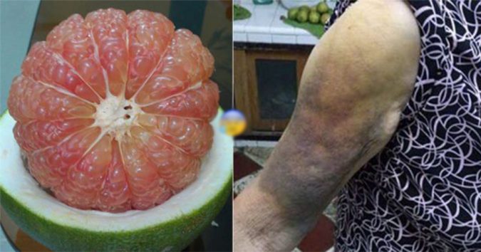 Bạn Có Thể Độ? ?ử Ngay Lập Tức Chỉ Vì Ăn 1 Múi Bưởi – Nhiều Người Không Biết Mà ?ấ? ?ạ?? Như Chơi