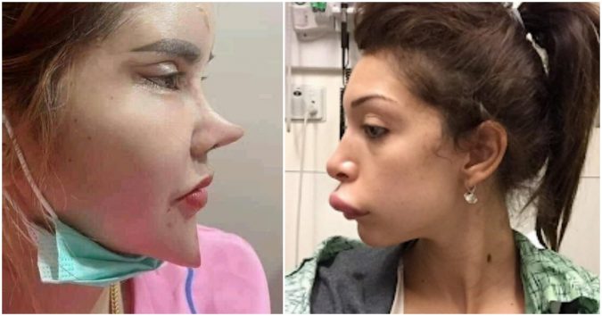 Lạ kỳ hình ảnh cô gái đi thẩ.m m.ỹ về, mũi, cằm nhọn hoắt bất thường