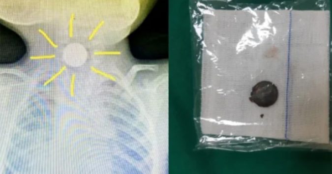 Bé 3 tuổi nôn ói, miệng đàm nhớt, nhập viện đã loét thực quản, thủ phạm là thứ nhà nào cũng có