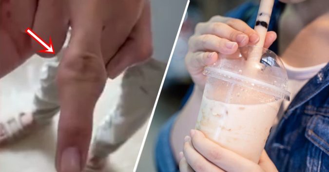 Dùng quá nhiều trà sữa, đồ ăn vặt nam sinh 14 tuổi bị phù khớp ngón tay